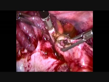 Ovarian Cancer Anexectomy