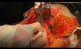 Pancreatico-Jejunostomy Reconstruction