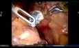 Robotic RUL Posterior Segmentectomy with ICG Guidance 