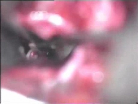 Microvascular Decompression of the Trigeminal Nerve