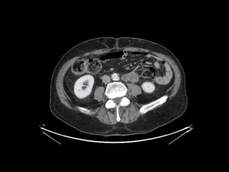 Case Presentation - Left Trisectionectomy with Caudate Lobectomy for Intrahepatic Cholangiocarcinoma