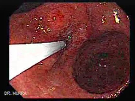 Adenocarcinoma of the Antrum and Incisura Angularis (3 of 3)
