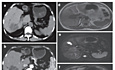 Intrahepatic Cholangiocarcinoma