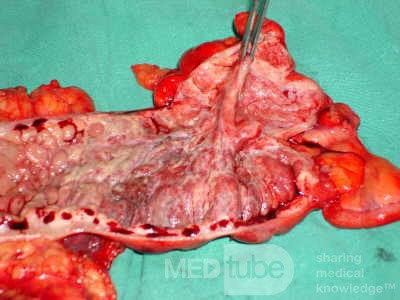 Severe case of Ischemic Colitis (19 of 19)