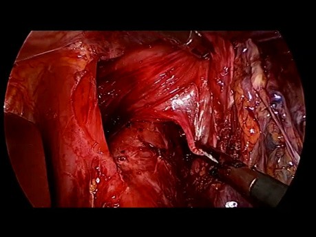 Total Laparoscopic Gastrectomy for Gastric Cancer