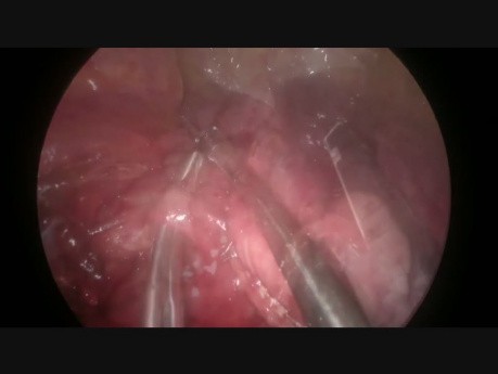 Uniportal VATS Enbloc Anatomic Segmentectomy S7 S4-5