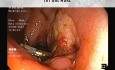Post-ESD-Resection-Bed Vessel vs Old Fashioned Clips