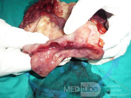Endoscopy of Scirrhous Gastric Carcinoma involving the entire Fundus, Body and the Antrum (36 of 47)