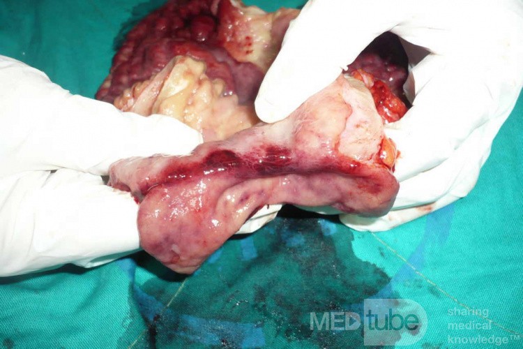 Endoscopy of Scirrhous Gastric Carcinoma involving the entire Fundus, Body and the Antrum (36 of 47)