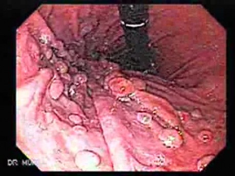 Hyperplastic Gastric Polyposis - Endoscopy (4 of 6)