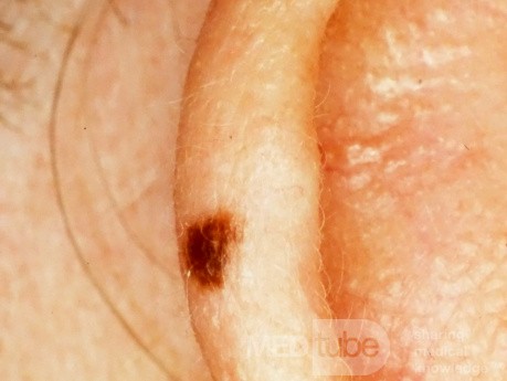 Junctional Nevus