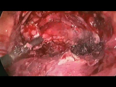 Scar Ectopic Pregnancy