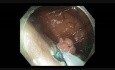Colonoscopy - Ascending Colon - Twin Lesion EMR and Closure