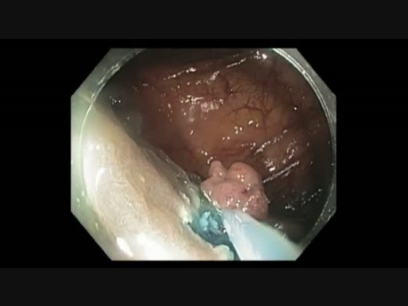 Colonoscopy - Ascending Colon - Twin Lesion EMR and Closure
