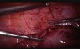 Myomectomy Type I Double