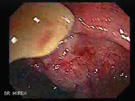 Status Post Rubber Band Ligation for Internal Hemorrhoids (6 of 7)