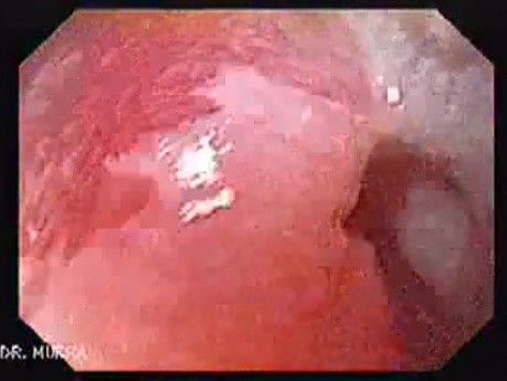 Longstanding gastroesophageal reflux disease (5 of 7)
