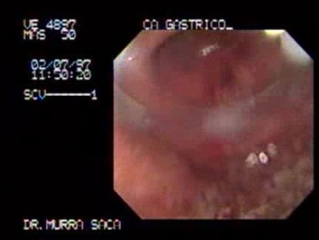 Gastric Adenocarcinoma - Obstruction 2