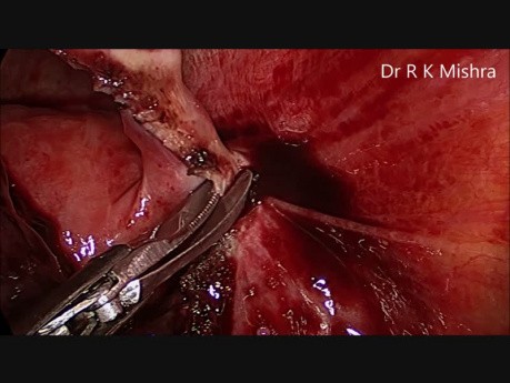 Laparoscopic Management of Ectopic Pregnancy