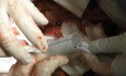 Open Surgical Repair of TAAA