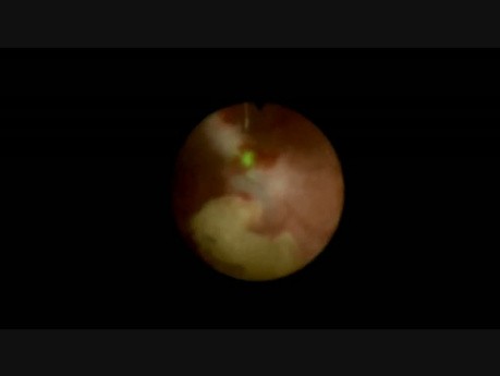 RIRS, Using Dual Channel Ureteroscope
