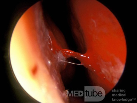 Active Epistaxis