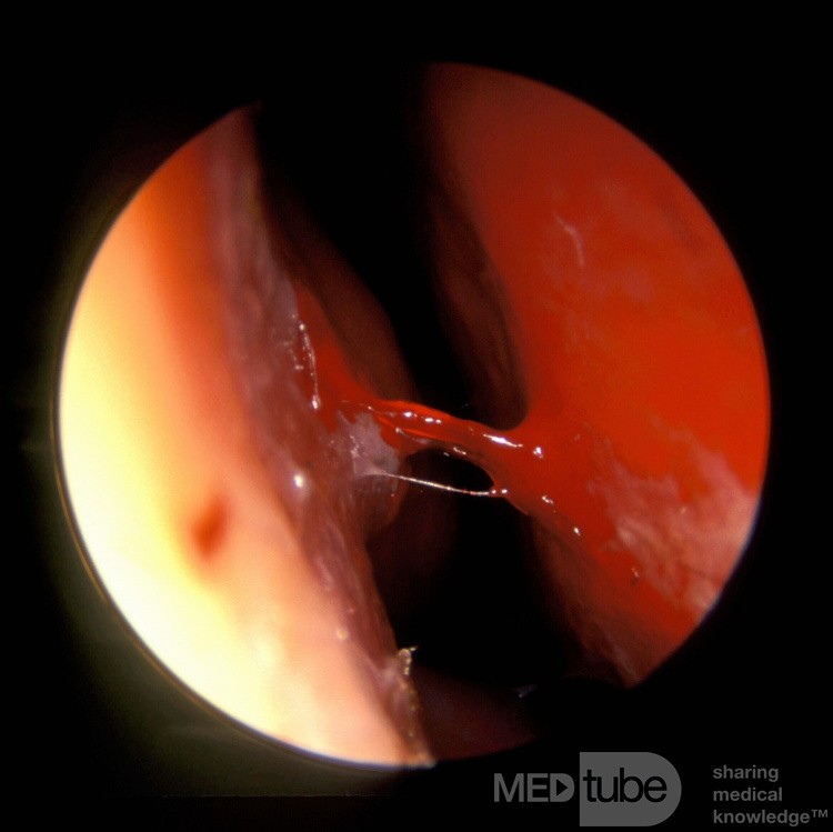 Active Epistaxis