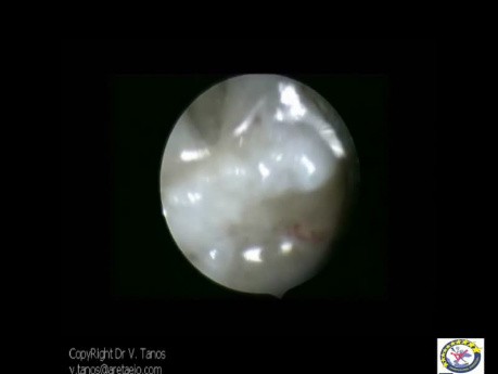 Adhesion Formation After Septectomy Seen In The  Second Look