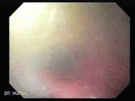 Tracheobronchitis - Bronchoscopic Image