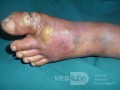 Infected Ulcer In The Big Toe Diabetic Man