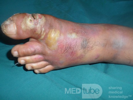 Infected Ulcer In The Big Toe Diabetic Man
