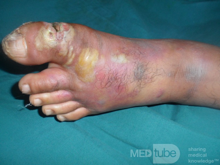 Infected Ulcer In The Big Toe Diabetic Man