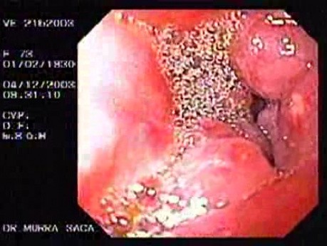 Duodenal B Cell Lymphoma (2 of 7)