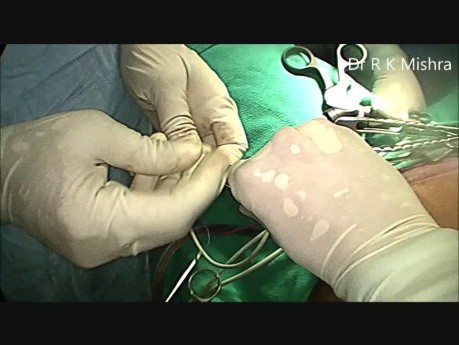 Total Laparoscopic Hysterectomy - TLH