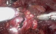 Ultra Minimally Invasive Single Port Robot-Assisted Pyeloplasty