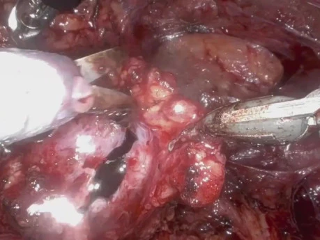Ultra Minimally Invasive Single Port Robot-Assisted Pyeloplasty