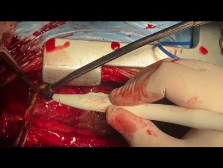 Extensive Tumor Resection with Direct Invasion From LT Lower Lobe of Lung LV Apex