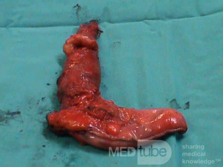 Barrett Adenocarcinoma - Endoscopic Image (16 of 20)