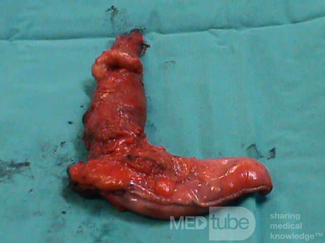 Barrett Adenocarcinoma - Endoscopic Image (16 of 20)