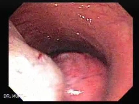 Huge Mass Of The Descending Colon (6 of 25)