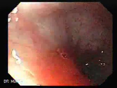 Adenocarcinoma of the Cardias - Proper Placement of the Stent