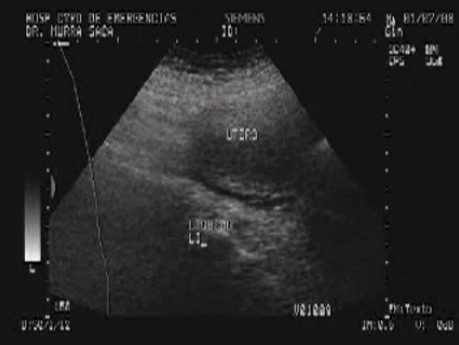 Ovarian Carcinoma with Gastric and Duodenal Metastases  - Ultrasonography