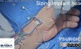 Thumb Basal Joint Replacement Surgery (CMC Arthroplasty)