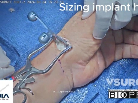 Thumb Basal Joint Replacement Surgery (CMC Arthroplasty)