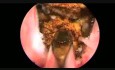 ThuLEP - Thulium Laser Enucleation of the Prostate