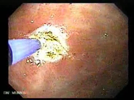 Gastroesophagic Varices (6 of 7)