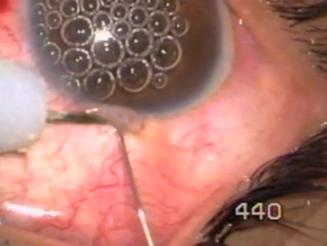 Juvenile Glaucoma. Singh Mictrotrack Filtration