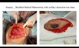 Management of Breast Lump - Case Discussion and Management 