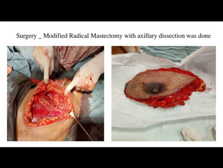 Management of Breast Lump - Case Discussion and Management 