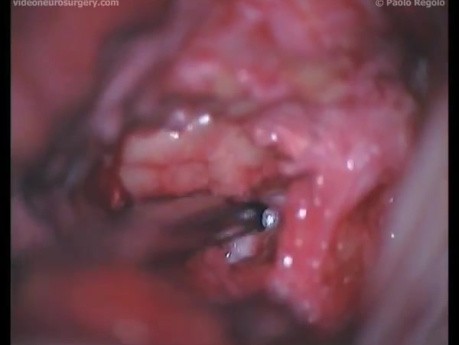 Lumbar Microdiscectomy - Posterior Approach